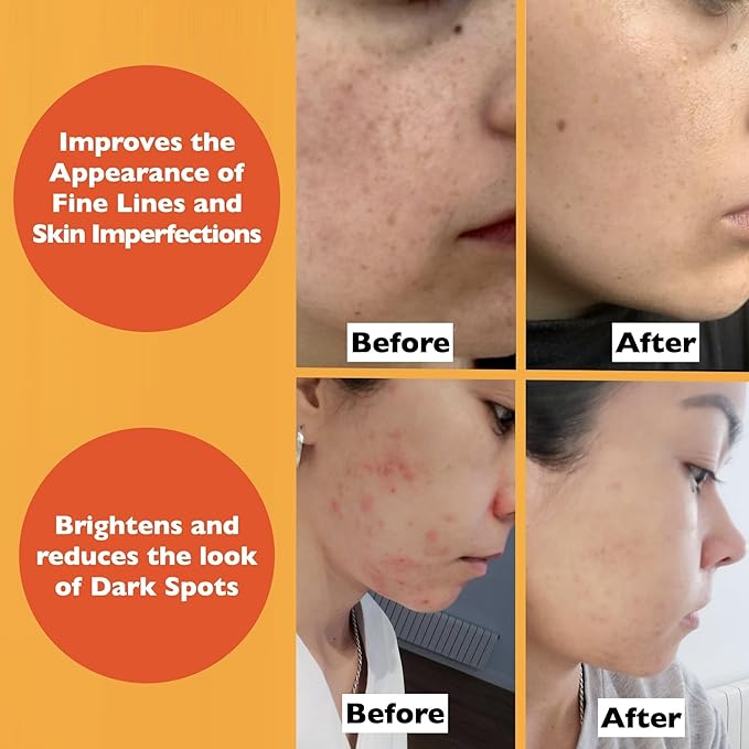 Vitamin C Serum For Face โ Anti-Aging Facial Serum with Vitamin C, Hyaluronic Acid, Niacinamide, B5 & Vit E. Brightening Facial Essence for Dark Spots, Fine Lines, Wrinkles & Glowing Skin, 2 Fl Oz