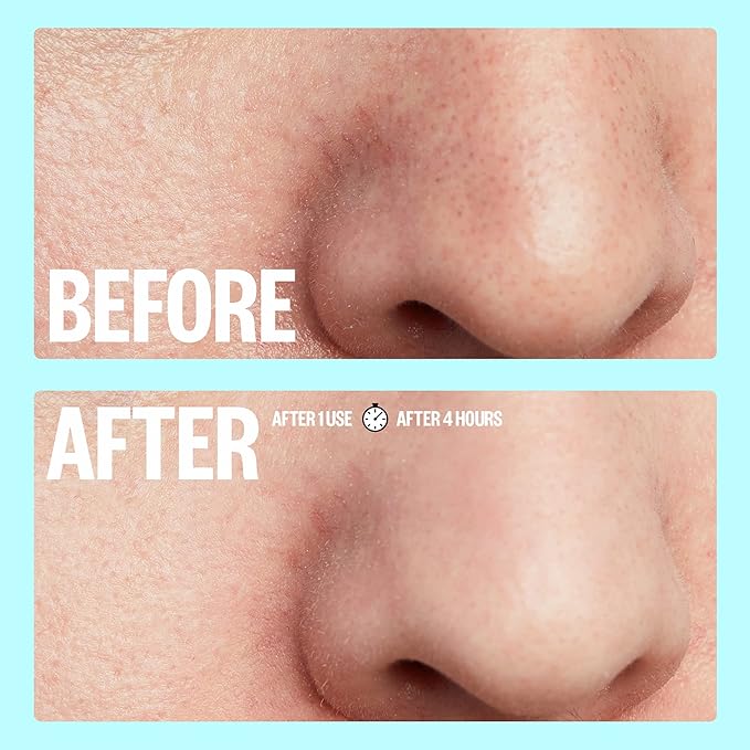 PEACE OUT Skincare Pore Minimizing Strips, Hydrocolloid Pore-Refining Nose and Face Strips with Retinol & Vitamin A to Shrink Enlarged Pores and Remove Blackheads (4 pore and 4 nose strips)