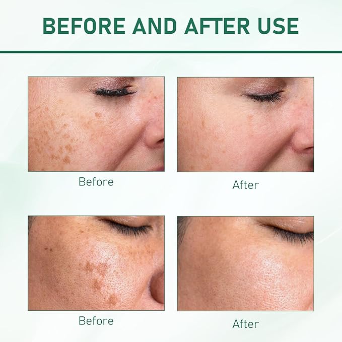 2Pcs Upgraded Anti-๐๐ซ๐๐๐ค๐ฅ๐ Essence Oil, 577 ๐๐ฉ๐จ๐ญ Remover Serum, Yuxintang Facial Spray, 577 Spray for Face, Body