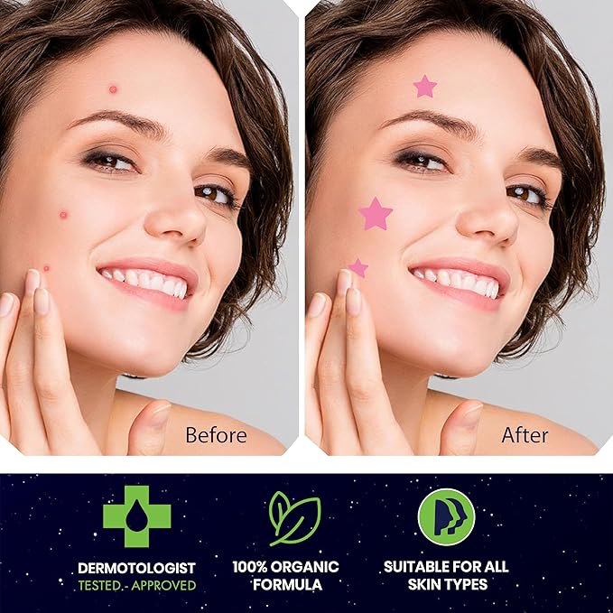 Star Pimple Patches for Face โ Hydrocolloid Acne Patches for Quick Zit Relief And Blemishes, Invisible Spot Stickers That Stay All Night, Gentle for All Skin Types, Oil-Free (80 Count)