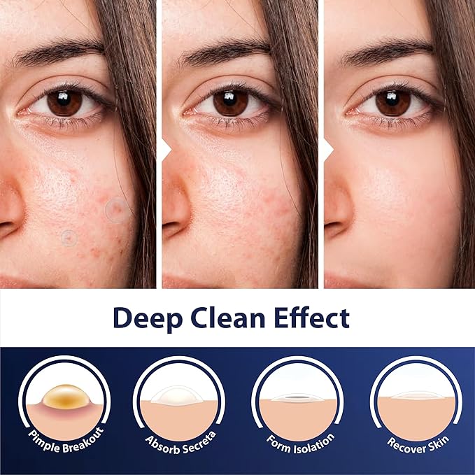 Dot Pimple Patches for Face โ Hydrocolloid Acne Patches for Quick Zit Relief And Blemishes, Invisible Spot Stickers That Stay All Night, Gentle for All Skin Types, Oil-Free (80 Count)
