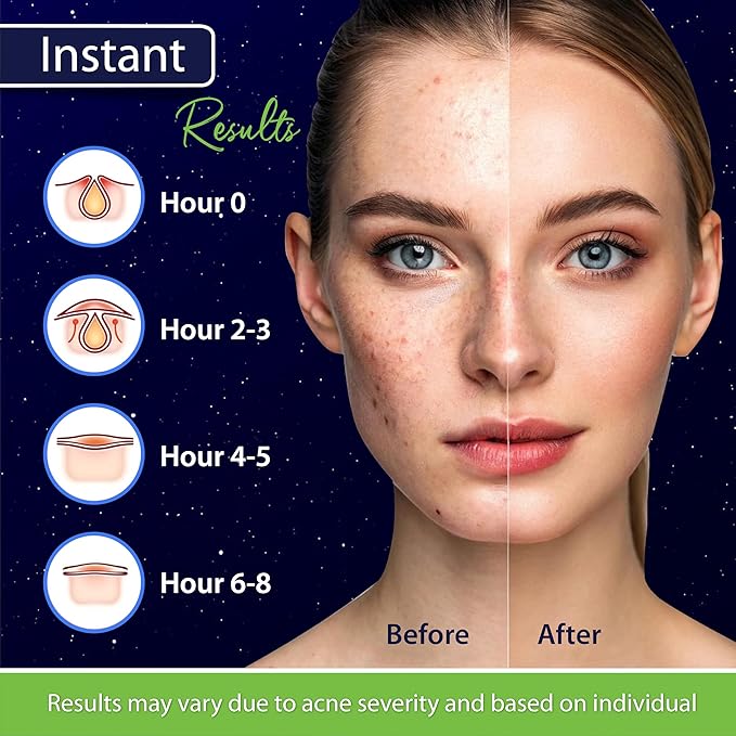 Star Pimple Patches for Face โ Hydrocolloid Acne Patches for Quick Zit Relief And Blemishes, Invisible Spot Stickers That Stay All Night, Gentle for All Skin Types, Oil-Free (40 Count)