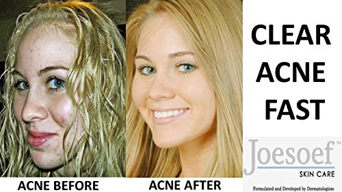 JOESOEF SKIN CARE Sulfur Soap Acne