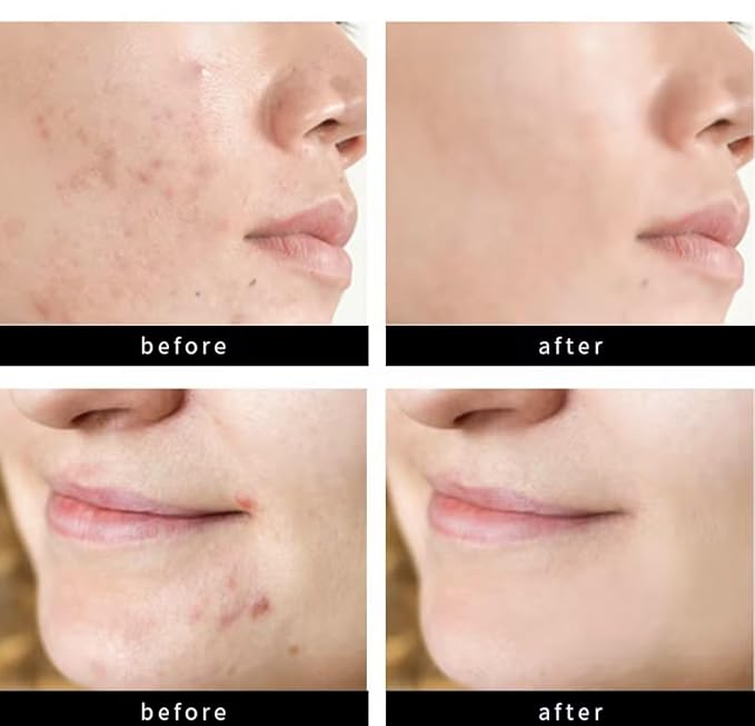 Acne Patch