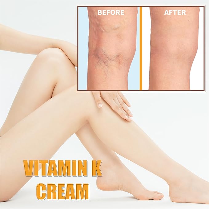 Varicose Veins Cream, Vitamin K Cream,