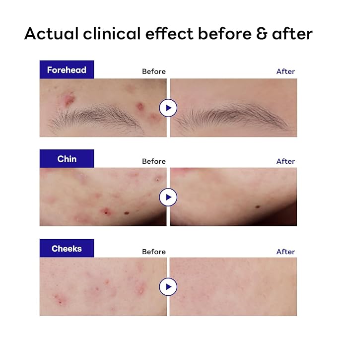 Mediheal Derma Clear Teatree Treatment Spot Patch (132 Counts) - Acne Relief, Oil and Moisture Balance with Teatree & Salicylic Acid