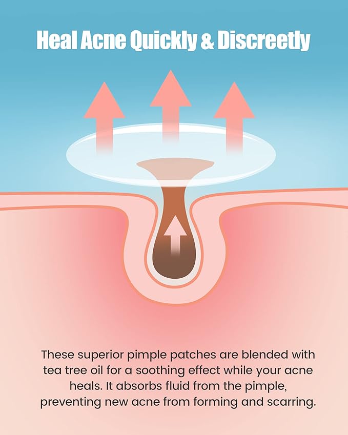 Pimple Patch 210 Counts 4 Sizes, Hydrocolliod Acne Patch for Face, Invisible Zit Patch with Tea Tree Oil & Calendula Oil, Blemish Patch, Vegan and Cruelty Free