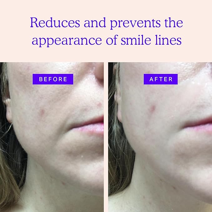 BLUMBODY Smile Line Patches – Face Wrinkle Patches for Fine Lines Around Mouth & between Eyes – Non-Silicone Anti-Wrinkle Facial Tape – Comfortable Overnight Use (90-Day Supply)