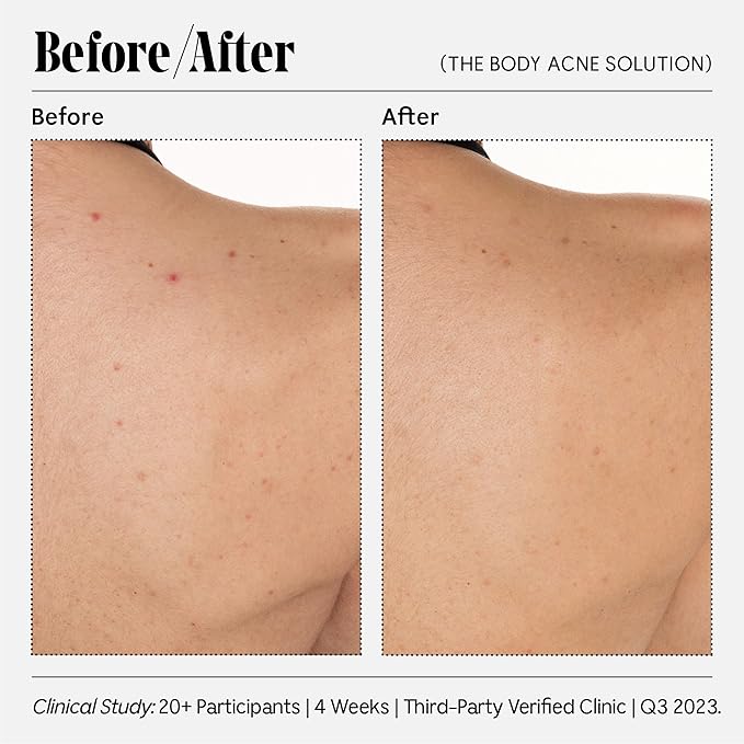 Necessaire Body Acne Solution