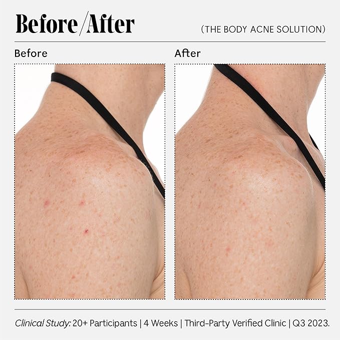 Necessaire Body Acne Solution